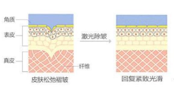 激光除皱