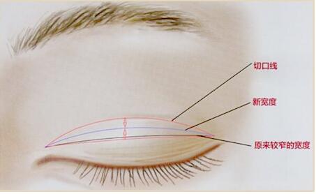 双眼皮修复