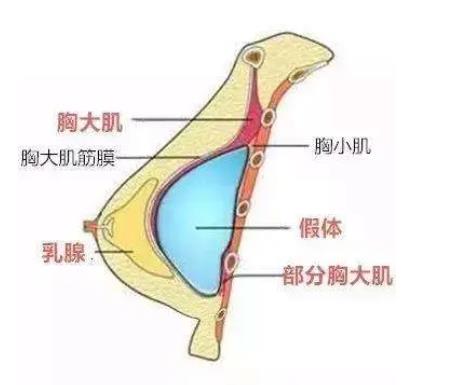 脂肪隆胸