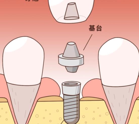 牙齿种植