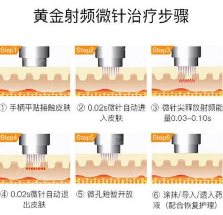 黄金微针多少钱一次?