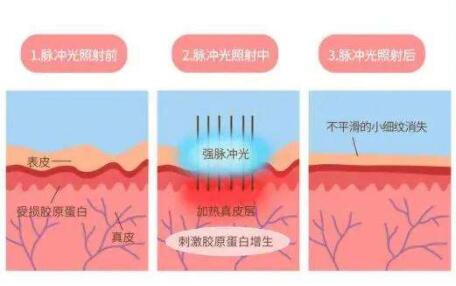 光子嫩肤和水光针一起做好吗?