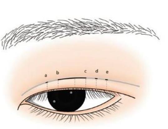 双眼皮