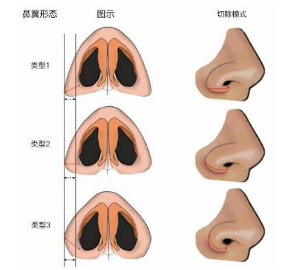 鼻尖整形手术的方法