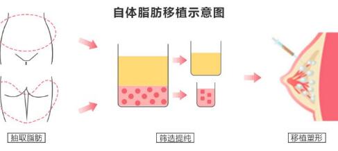 自体脂肪注射式隆胸有危害吗?