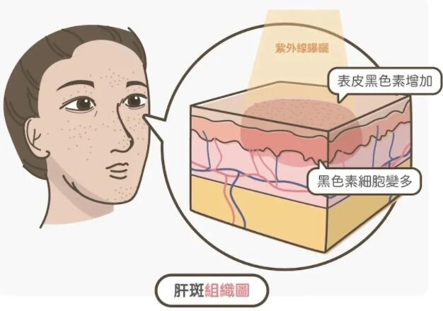 量子微雕怎么样效果好吗？可以改善色斑、皱纹、毛孔粗大、痘印~