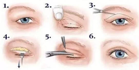 武汉五洲整形外科医院双眼皮案例