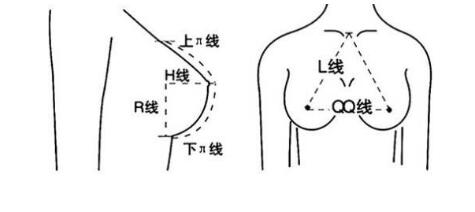 玻尿酸丰胸优缺点?