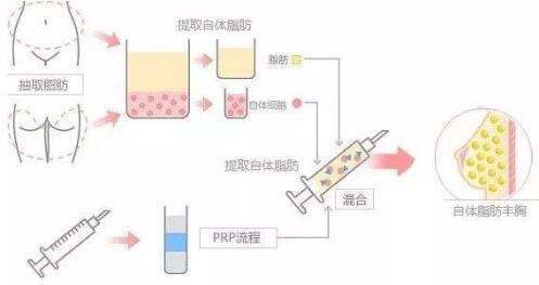 脂肪填充丰胸有哪些优势?