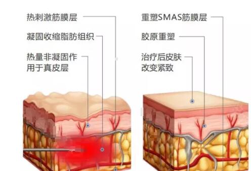 欧洲之星的疗效和副作用是什么?