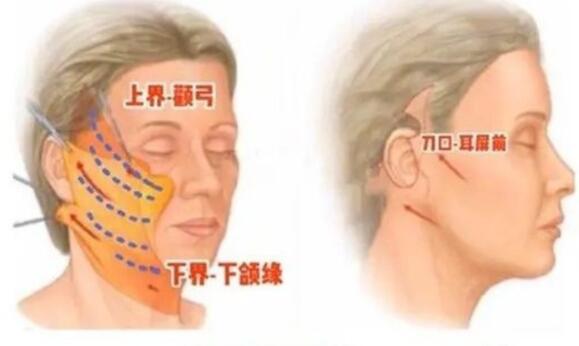 成都中医药大学附属医院整形科拉皮除皱案例分享