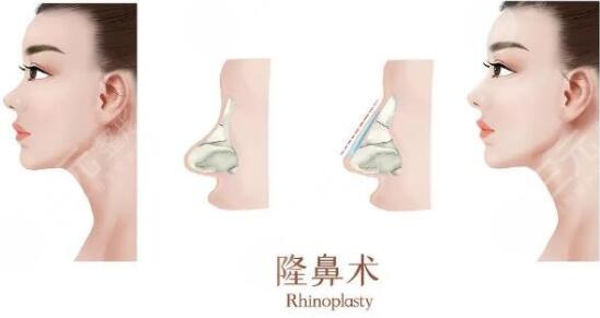 深圳阳光整形医院隆鼻怎么样?