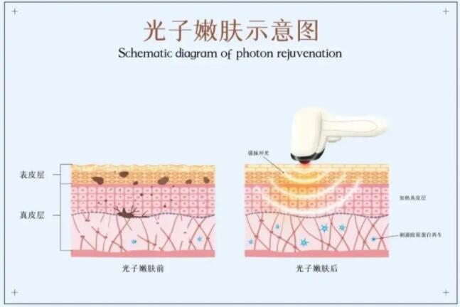 光子嫩肤注意事项