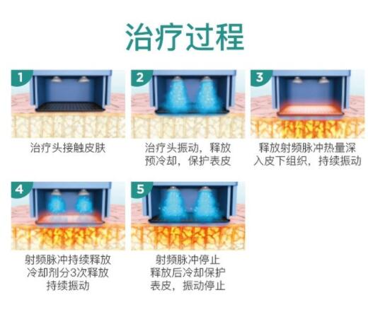 热玛吉操作需要麻醉吗?