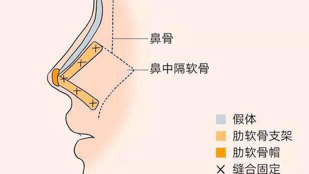 肋骨隆鼻原理是什么?