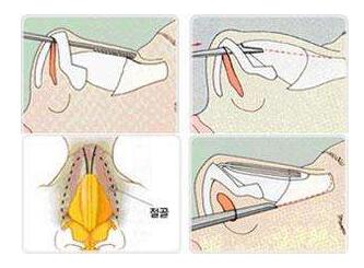 假体隆鼻的原理是什么?
