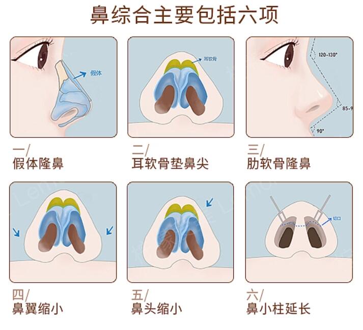 假体隆鼻的危害有哪些?