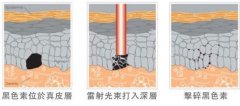 皮秒祛斑一次多少钱？