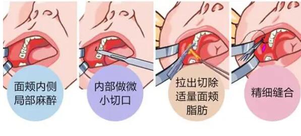 颊脂垫会下垂吗?