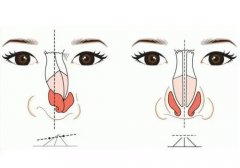 柳叶假体鼻中隔隆鼻要多少钱？材料有什么区别？